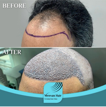 Slider image (4) United Hair Clinic